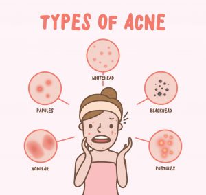 Types Of Acne Scars You Should Know