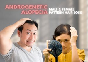 Androgenic Alopecia hair loss