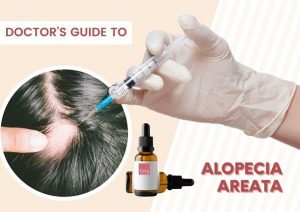 Guide to Alopecia Areata Treatment | Eeva Medical Clinic