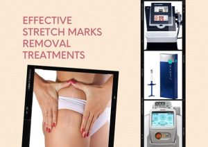 stretch mark removal treatments 