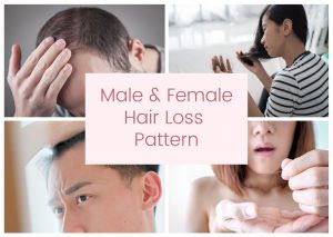 male & female hair loss
