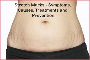 stretch marks clinic