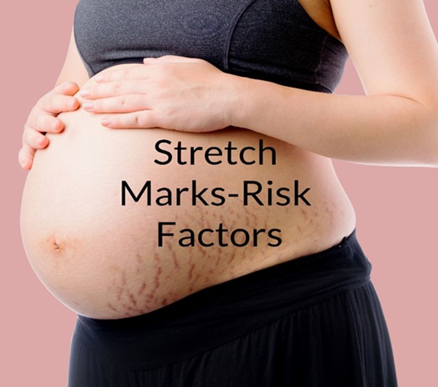 stretch marks pregnant