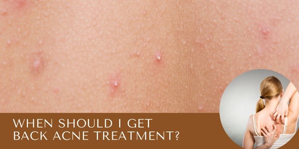 When Should I Get Back Acne Treatment Singapore?