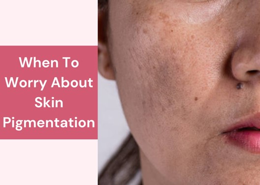 When To Worry About Skin Pigmentation
