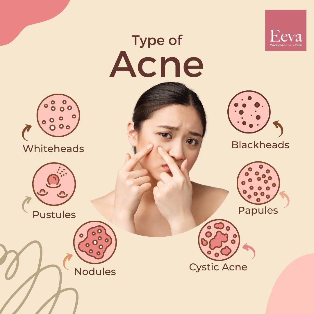 What Is Acne Explained Prevention Causes And Treatments Eeva Medical Aesthetic Clinic